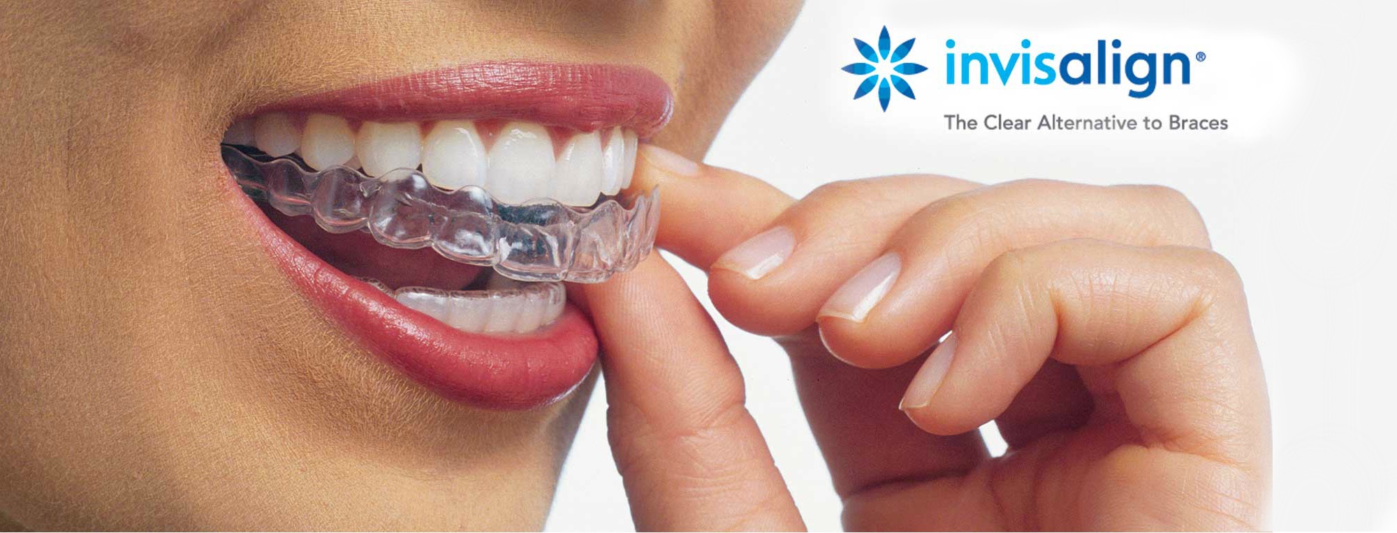 About Invisalign® - The Brace Space